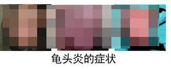 河池男性龟头炎如何检查