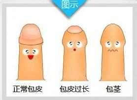 男性割包皮的佳时间？