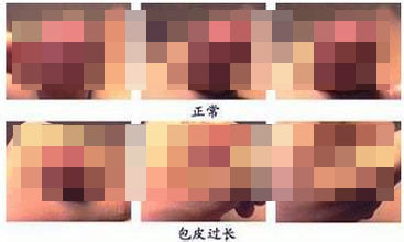 如何判断儿童是否包皮过长呢? 如何判断儿童是否包皮过长呢?