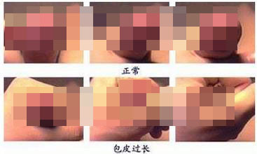 包皮过长不割除可以吗?