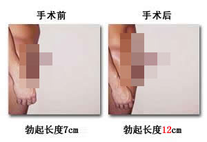 河池做阴茎延长医院哪家好呢? 河池做阴茎延长医院哪家好呢?