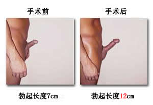 阴茎短小的原因有什么? 阴茎短小的原因有什么?