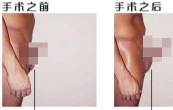 阴茎短小易引起哪些并发症 阴茎短小易引起哪些并发症