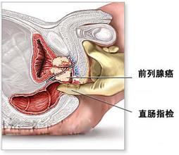 前列腺结石早期有哪些症状该如何治疗